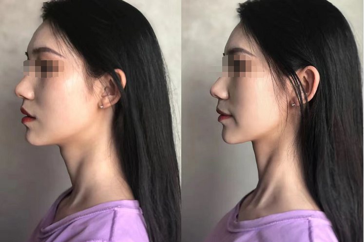 下颌缘提升效果图