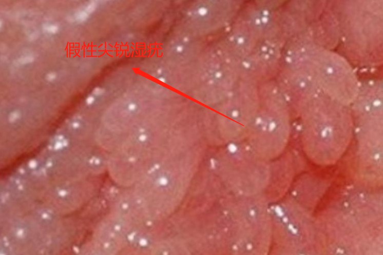 假性尖锐湿疣