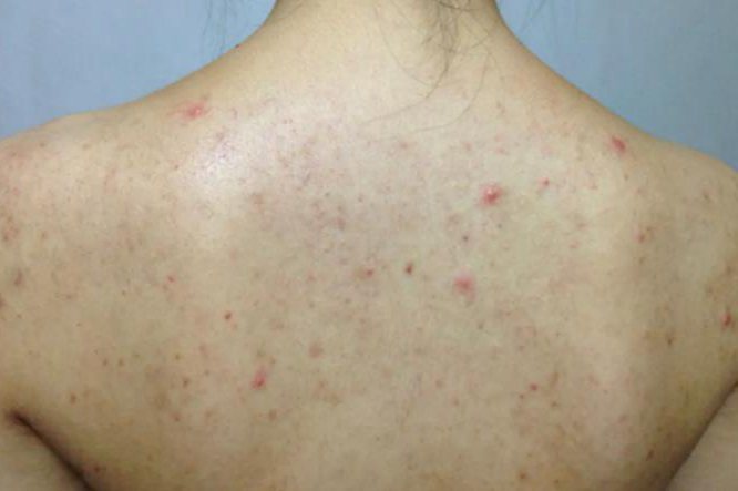 后背痤疮