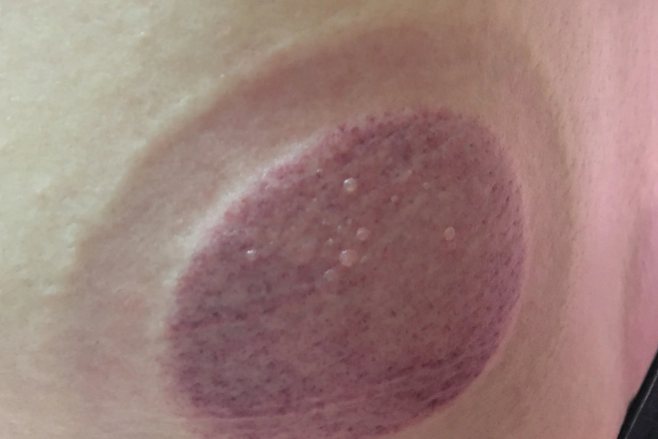 艾灸湿气重起水泡