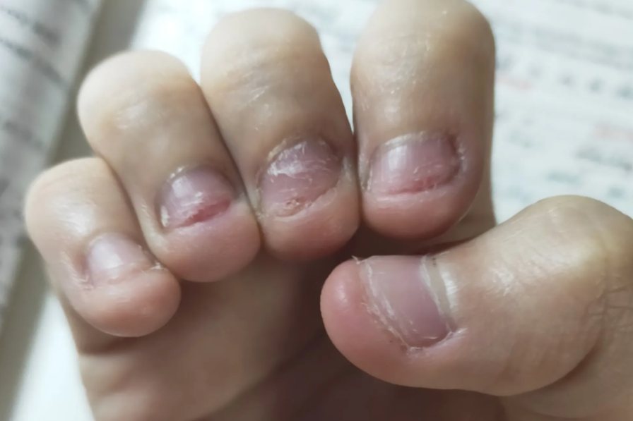 咬指甲后症状