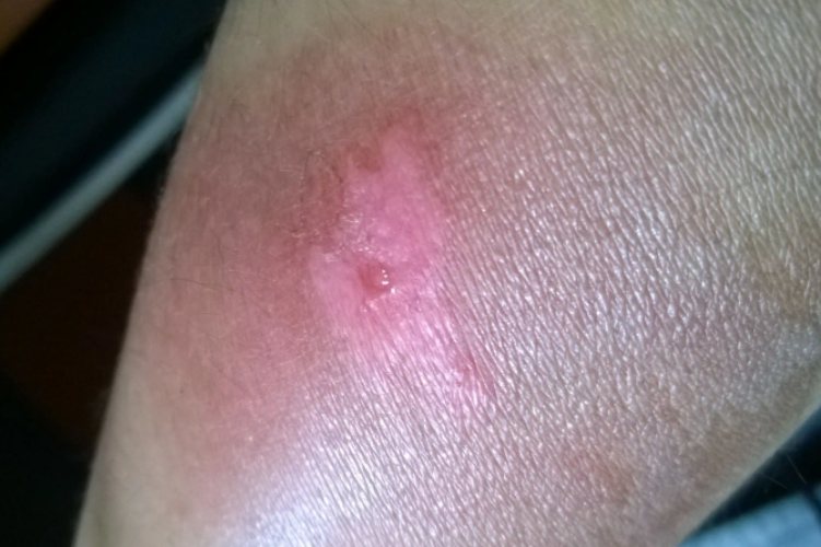 伤口愈合后留下的白斑