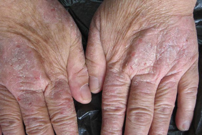 慢性肥厚性湿疹