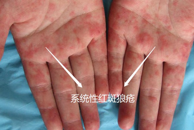 系统性红斑狼疮