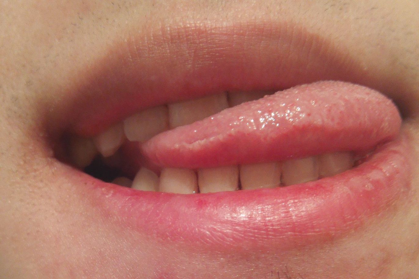 舌头上扁平疣