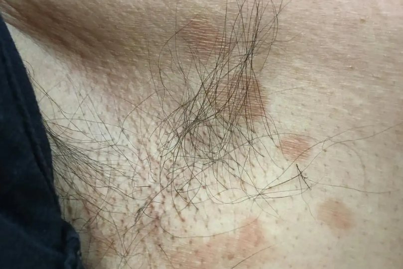 色素性毛表皮痣