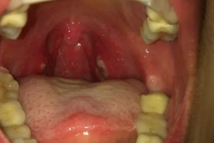 扁桃体化脓局部