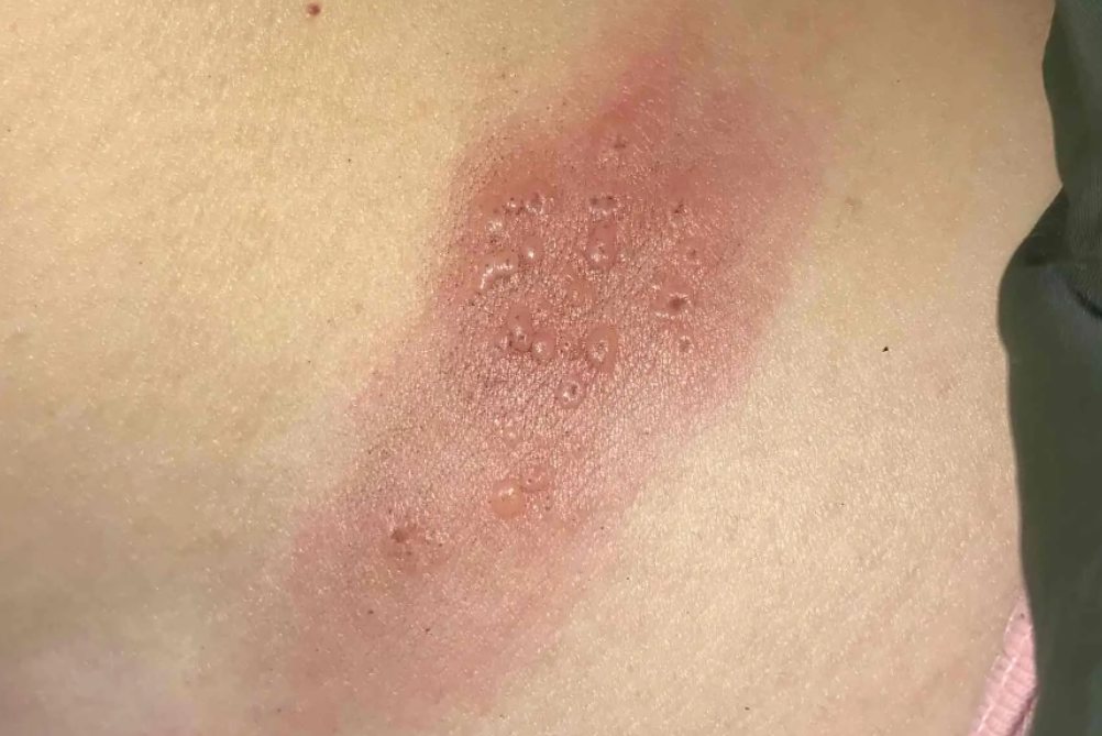 女性腰部带状疱疹图片