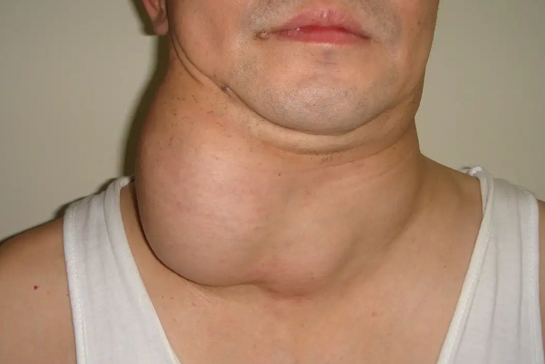 结节性甲状腺肿