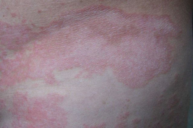 大斑块状副银屑病