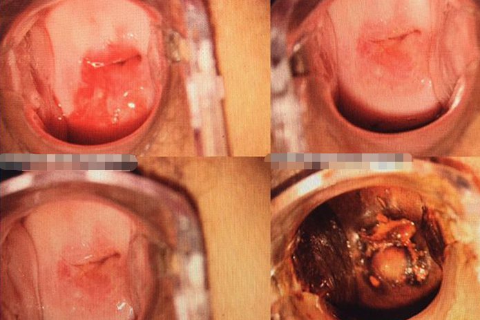 hpv感染宫颈病变