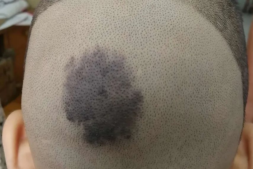 头皮色素痣