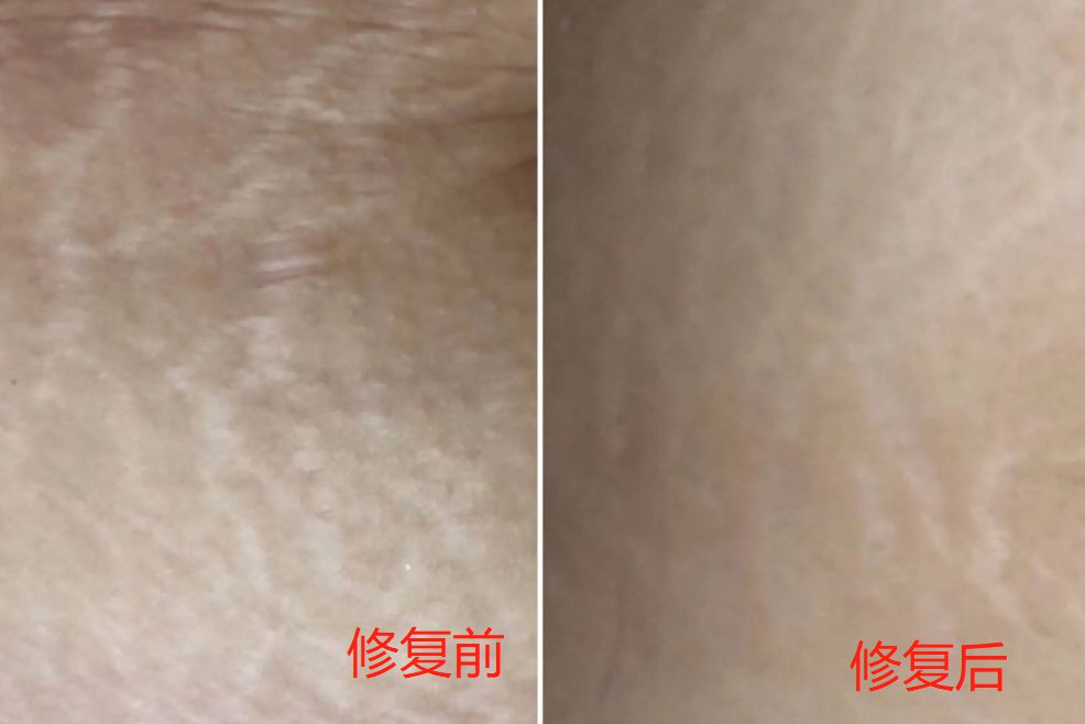 点阵激光去妊娠纹效果