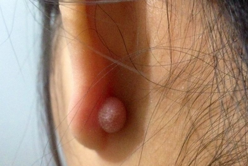 打耳洞长瘢痕疙瘩