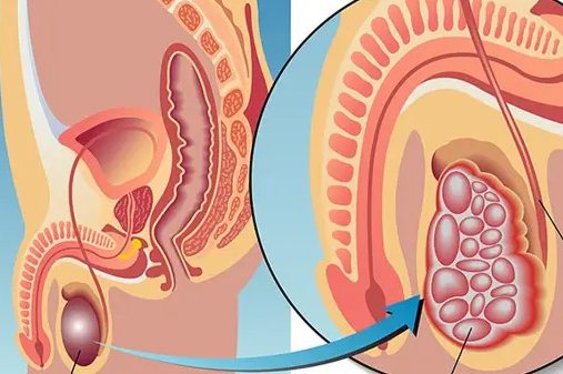 丝虫病早期症状
