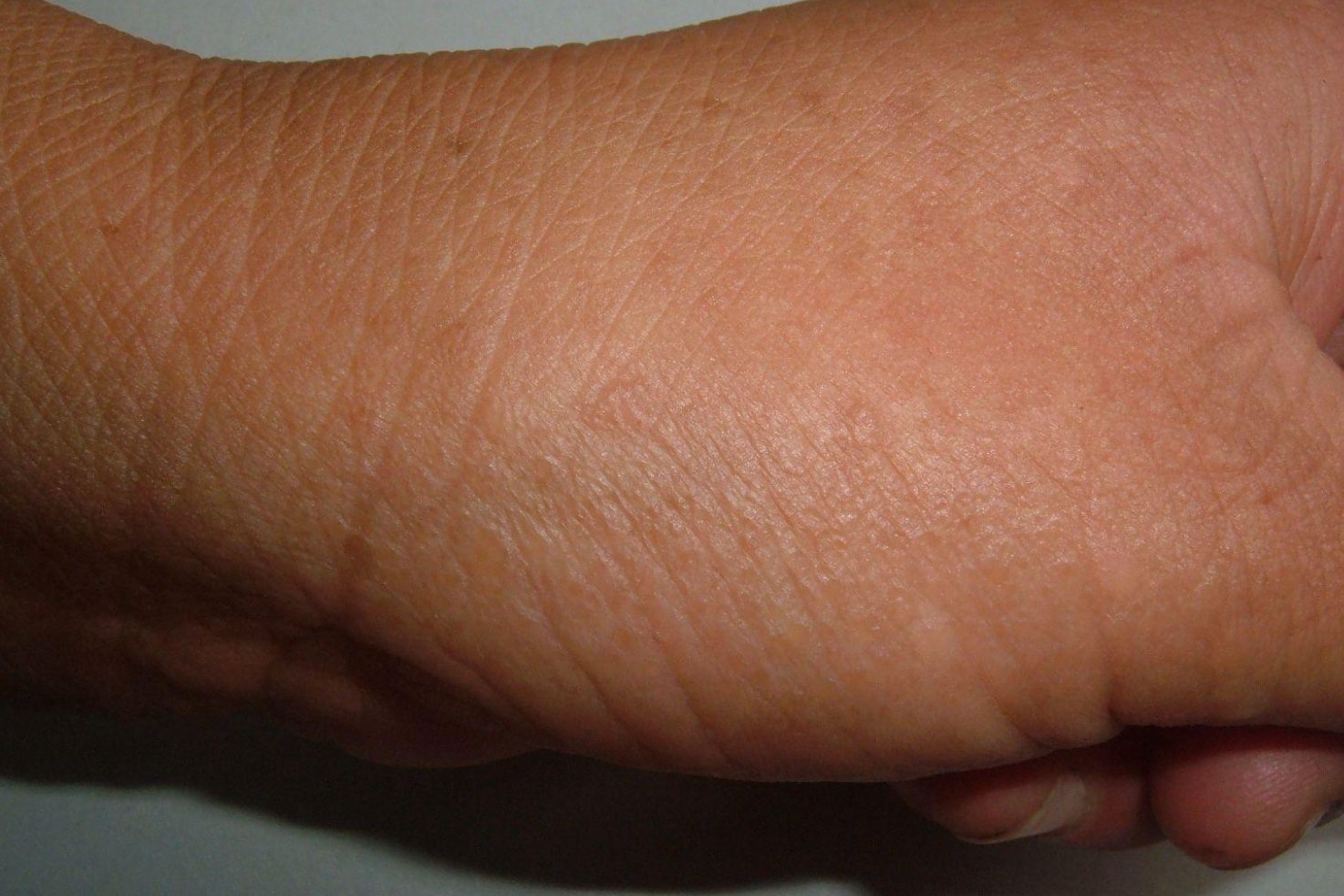 疣状表皮发育不良