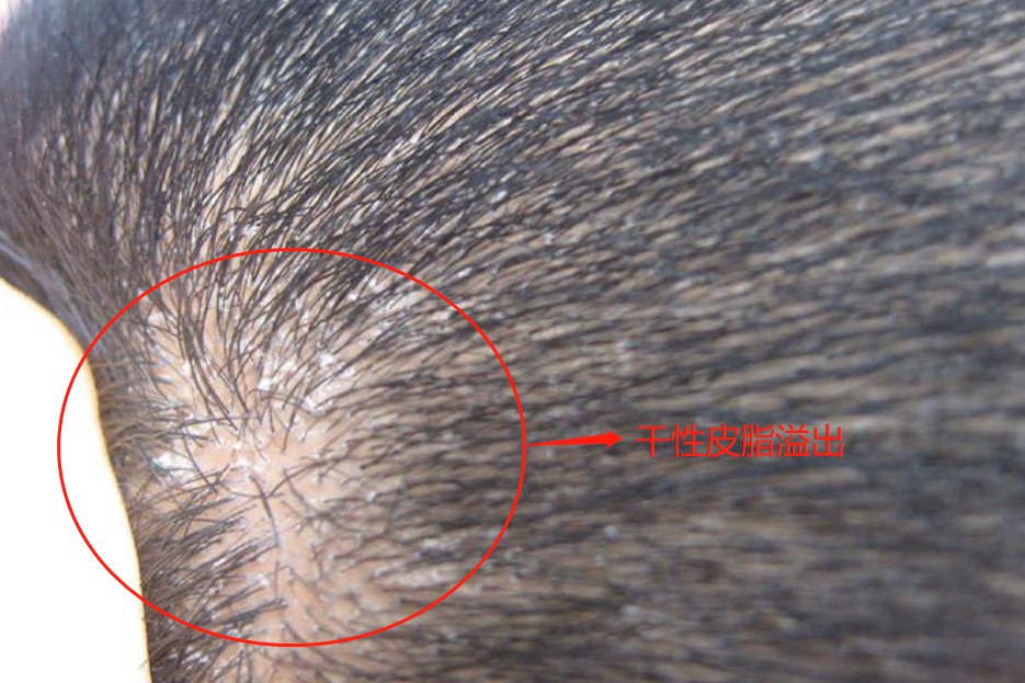 干性皮脂溢出图片