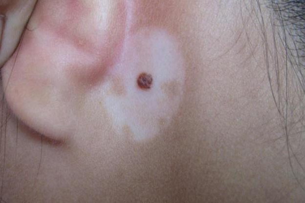 晕痣的早期症状