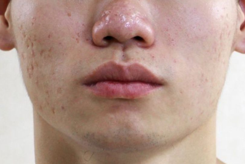 二氧化碳点阵激光祛痘印前