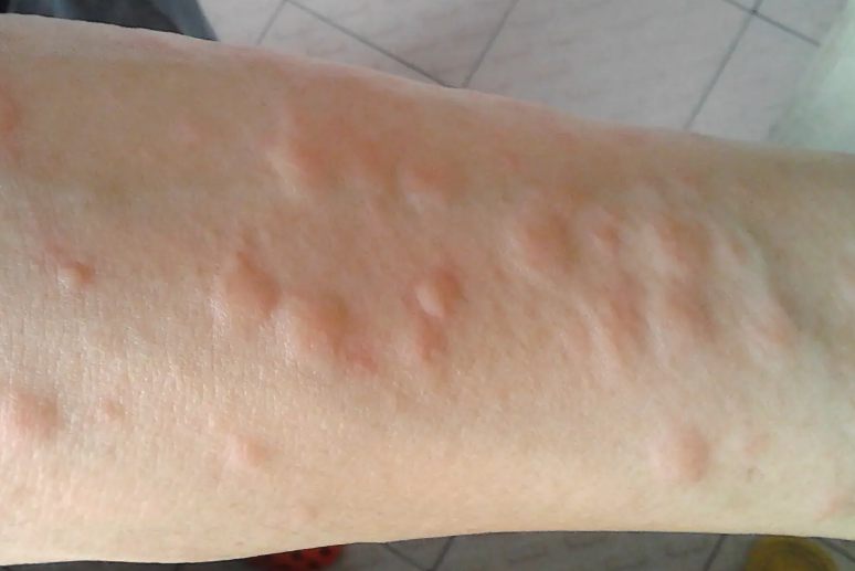 刺毛虫被咬了后图片