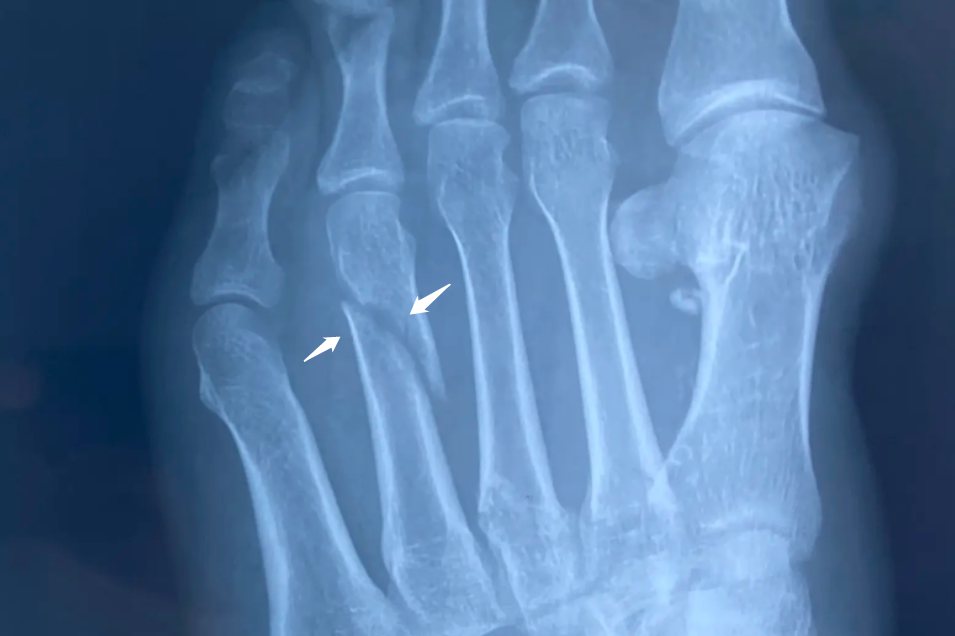 跖骨骨折十级伤残