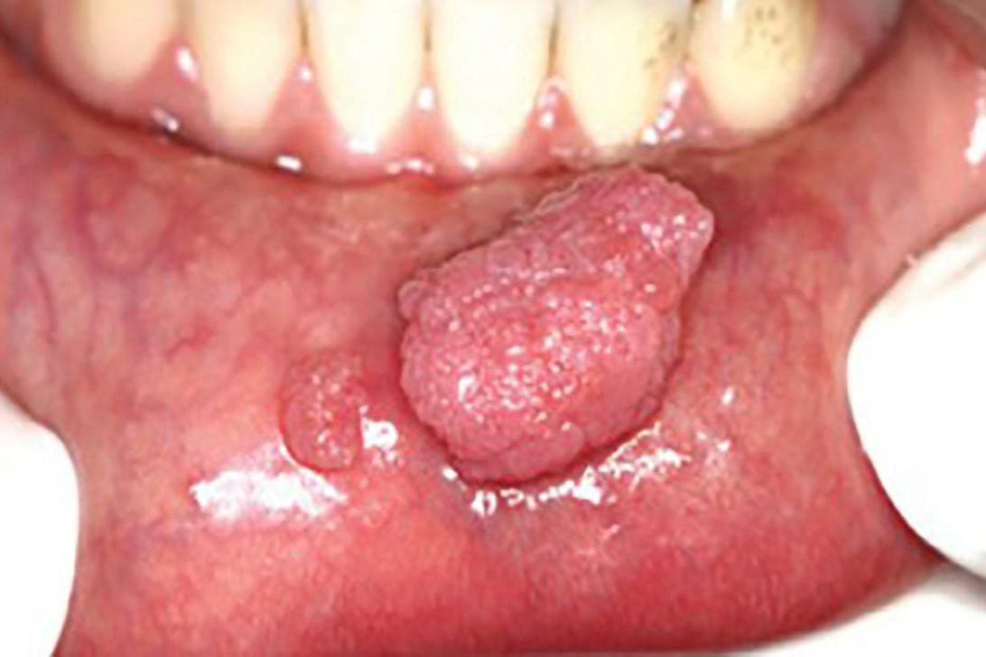 嘴唇上长病毒疣