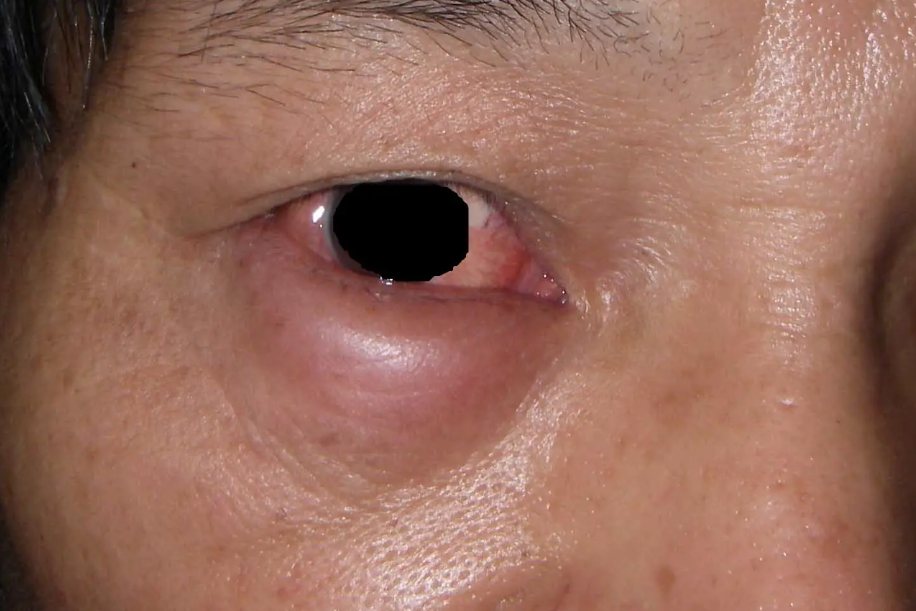 皮肤炎症皮肤水肿