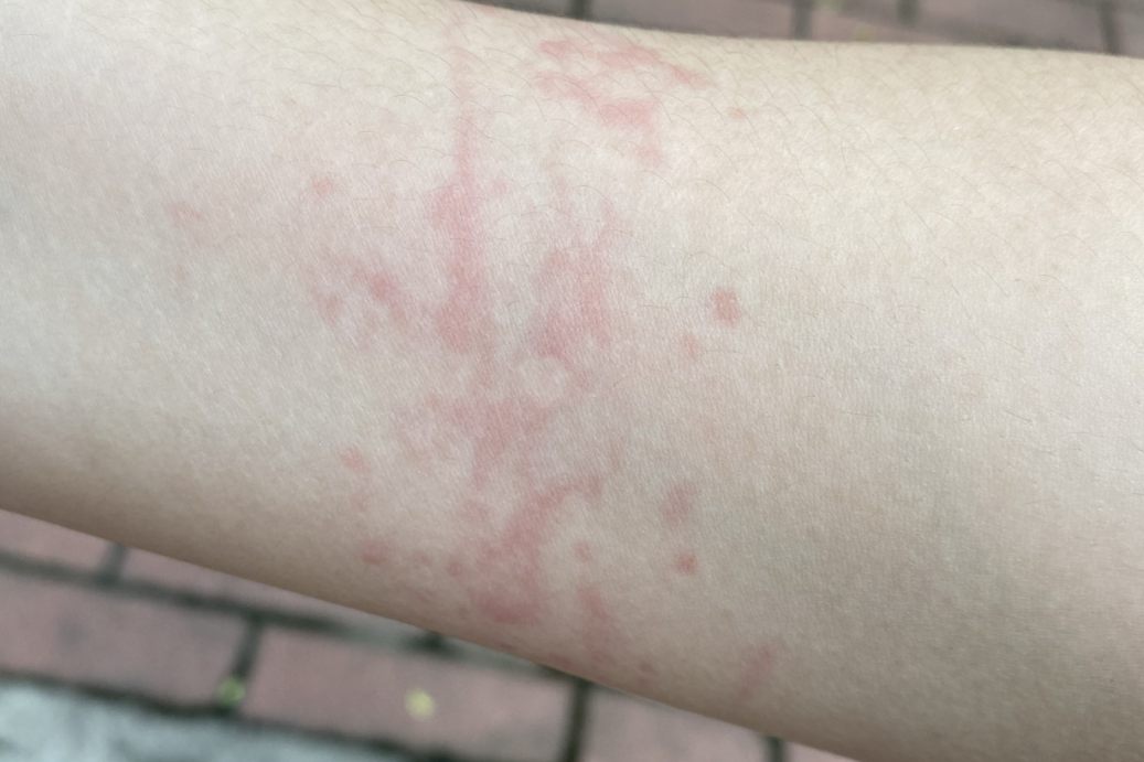 荨麻疹性血管炎