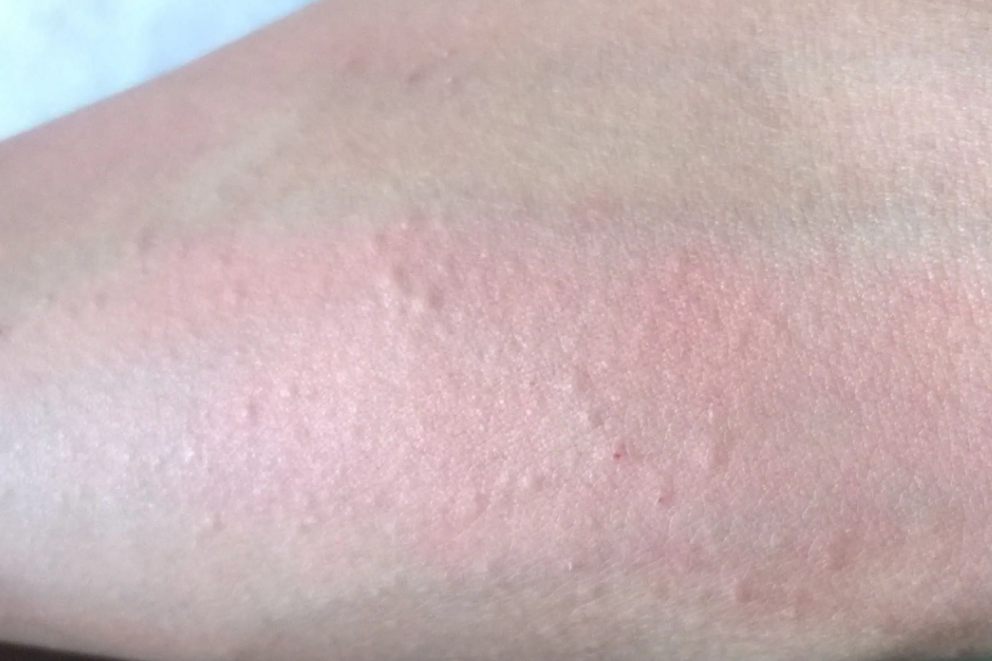 百香果皮肤过敏