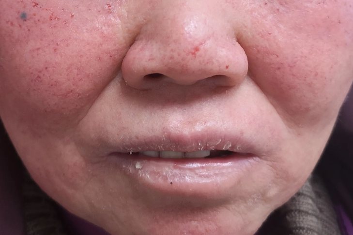 嘴角寻常疣
