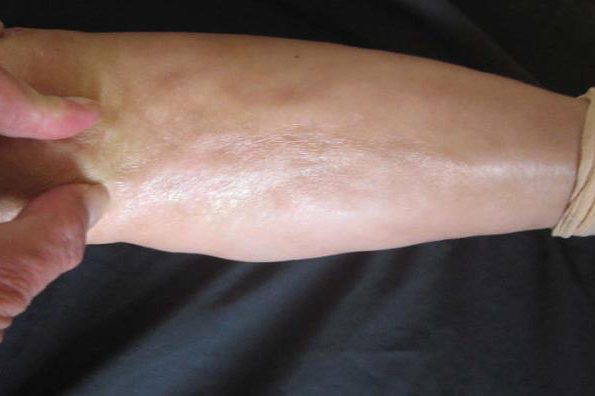 弥漫性皮肤增厚硬化