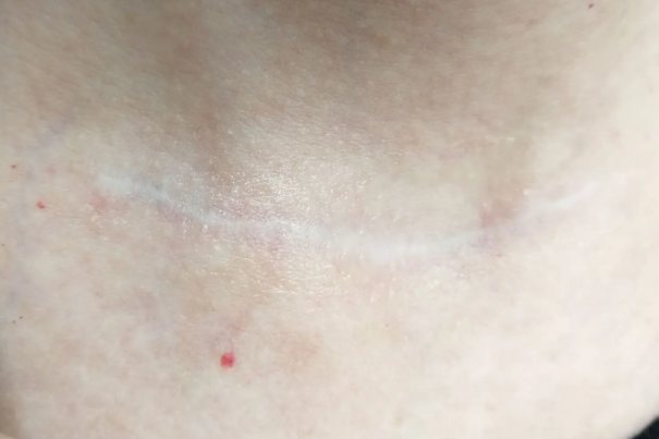 开放式手术伤口