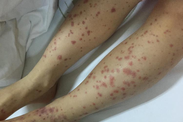 血小板减少性紫癜