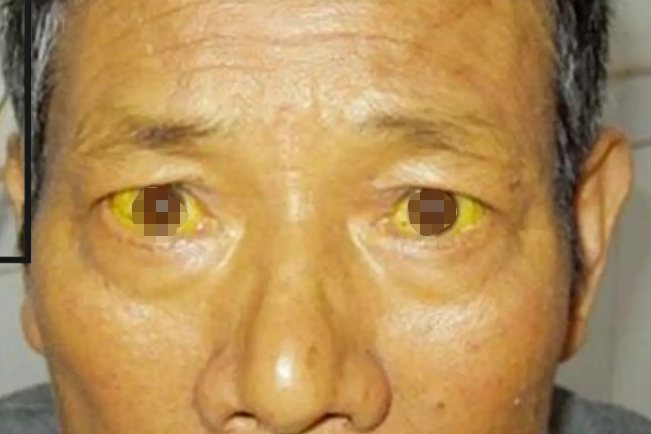 肝胆道疾病黄疸