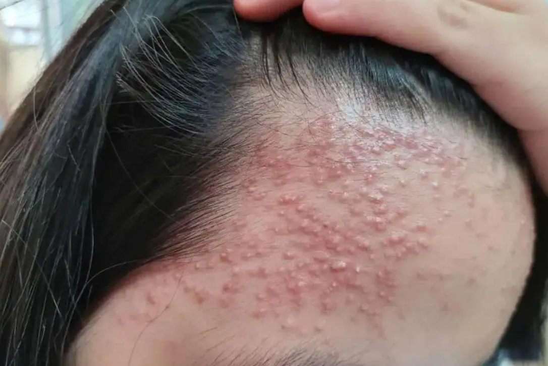 毛囊炎