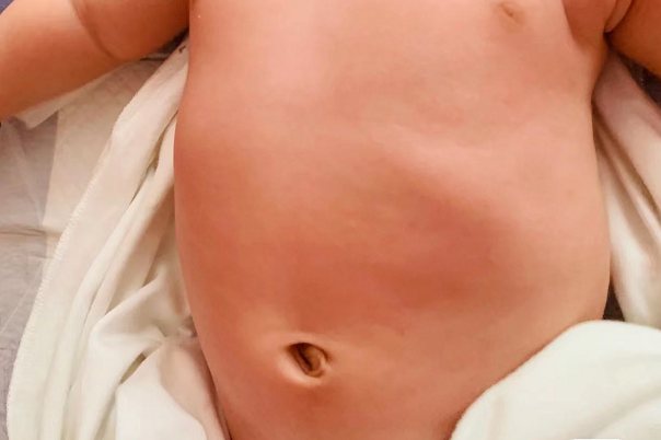 正常儿童的肚子图片