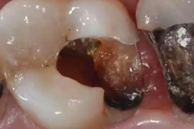 牙齿发霉的图片