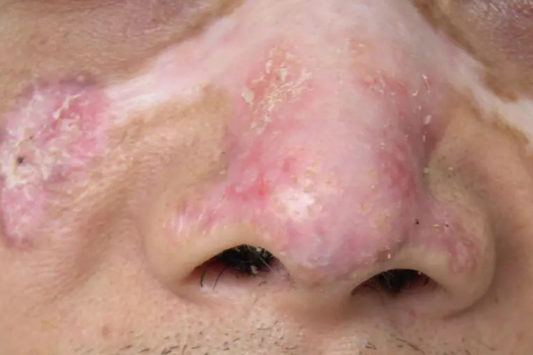 盘状红斑狼疮早期图