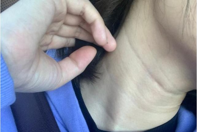 正常颈部淋巴结