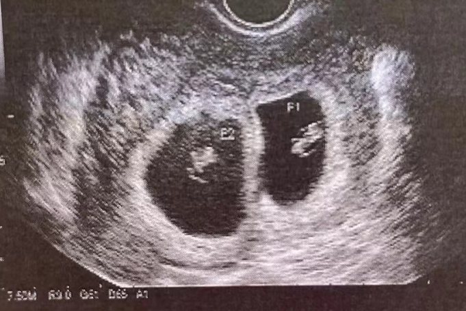 异卵双胞胎b超图