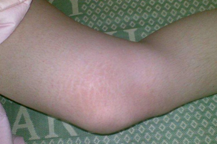 女生腿上生长纹图