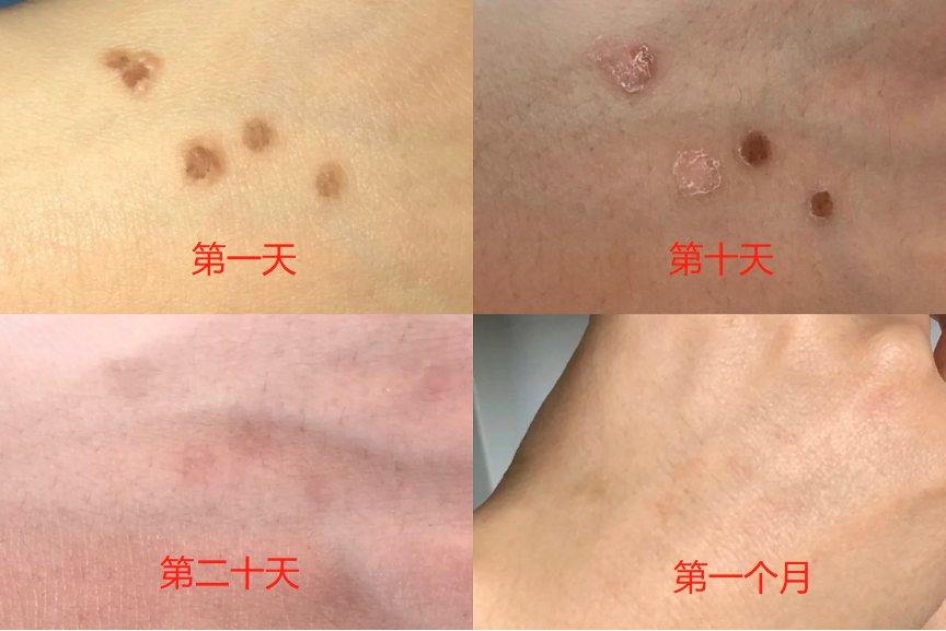 液氮冷冻恢复过程