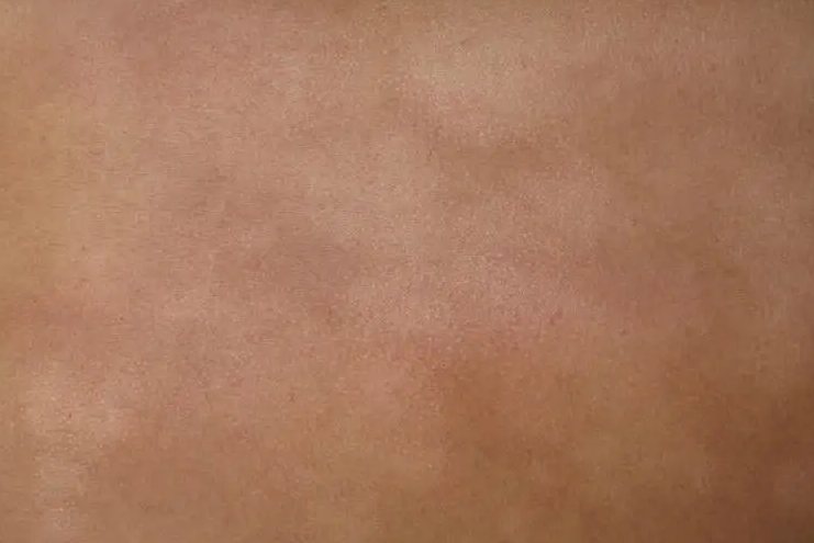 炎症消退后白斑