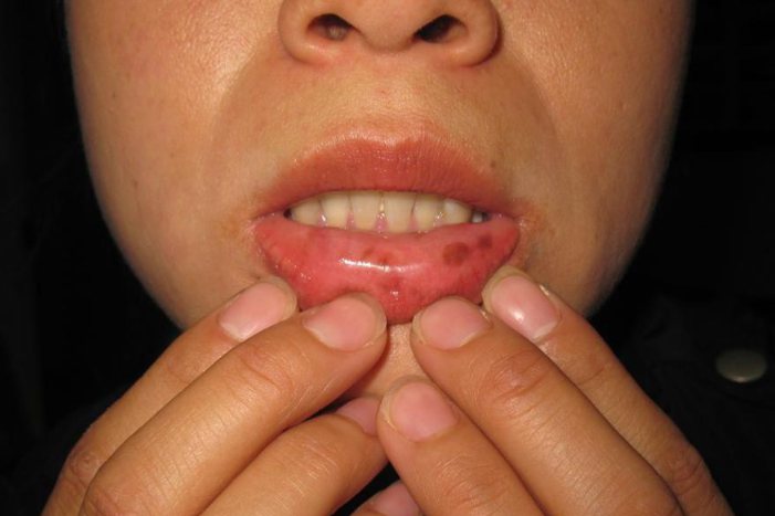 黑斑息肉综合症