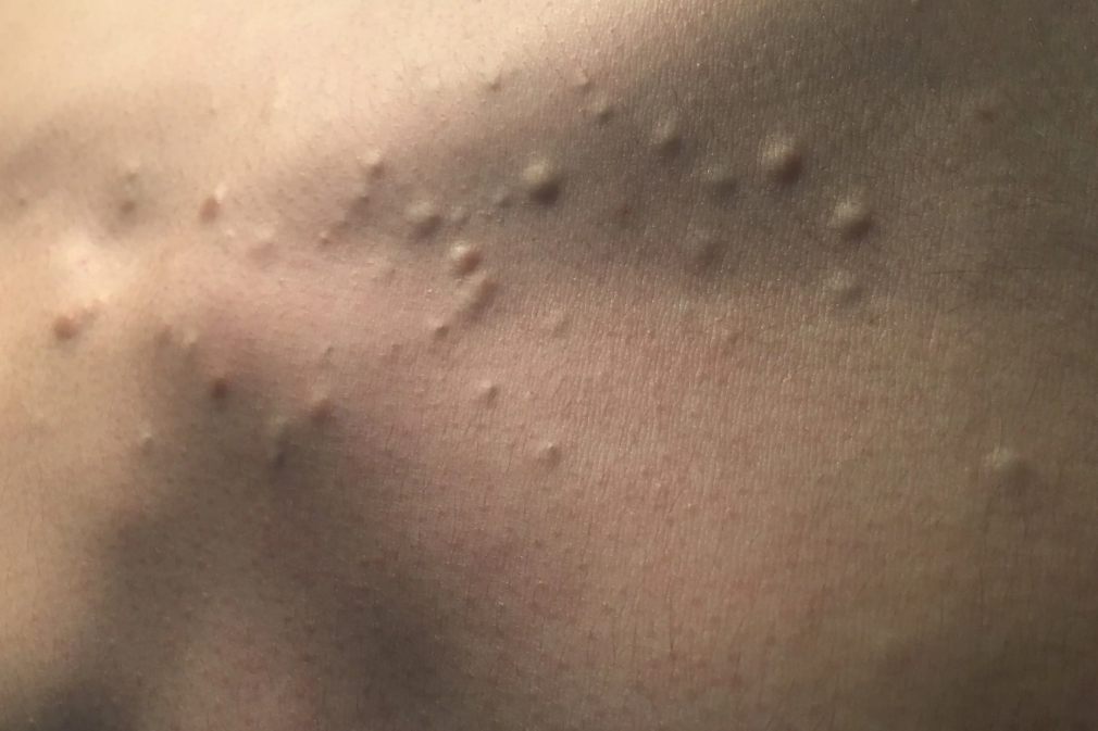 背部皮脂腺囊肿