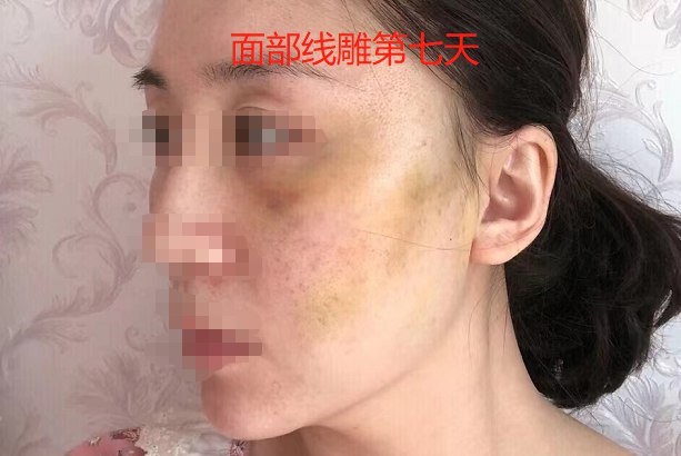 面部线雕第7天