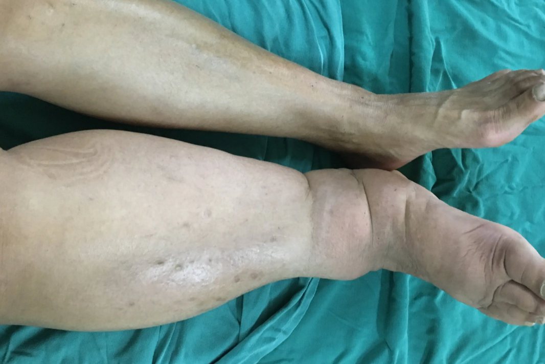 非凹陷性水肿