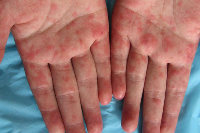 系统性红斑狼疮