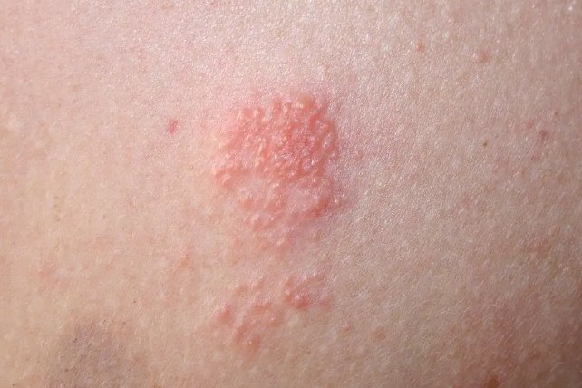 带状疱疹初期图片