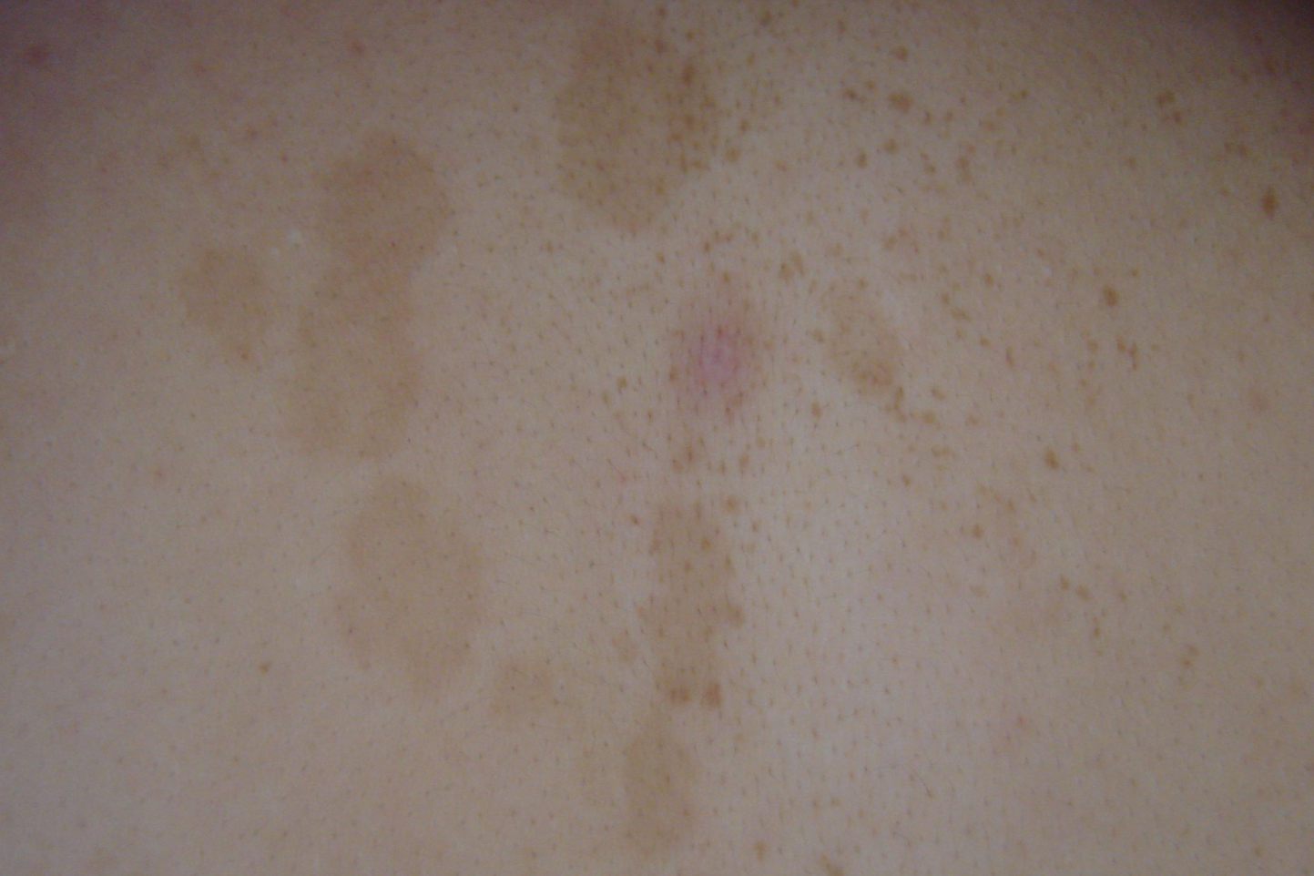 玫瑰糠疹留下的色素沉着